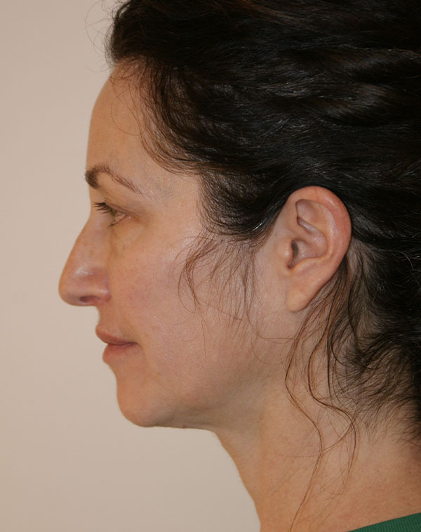 Photo of Patient 25 Before Face And Neck Lift Procedure