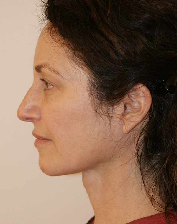 Photo of Patient 25 After Face And Neck Lift Procedure