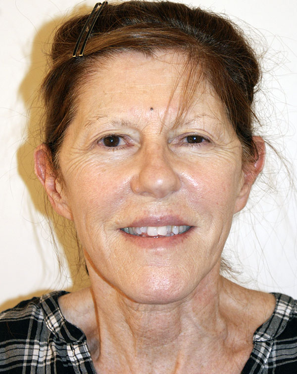 Photo of Patient 26 Before Face And Neck Lift Procedure