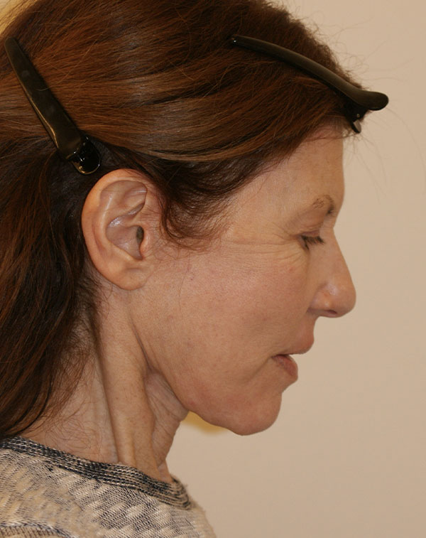 Photo of Patient 26 After Face And Neck Lift Procedure