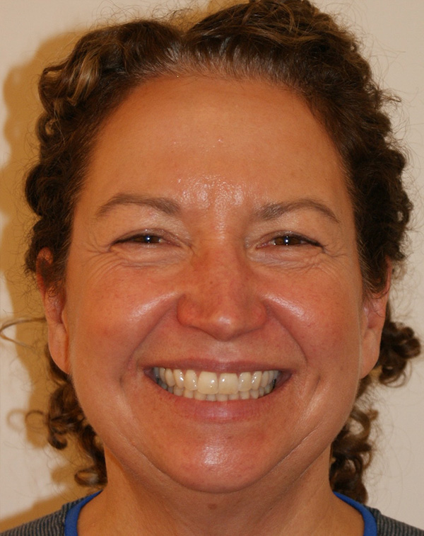 Photo of Patient 28 Before Face And Neck Lift Procedure