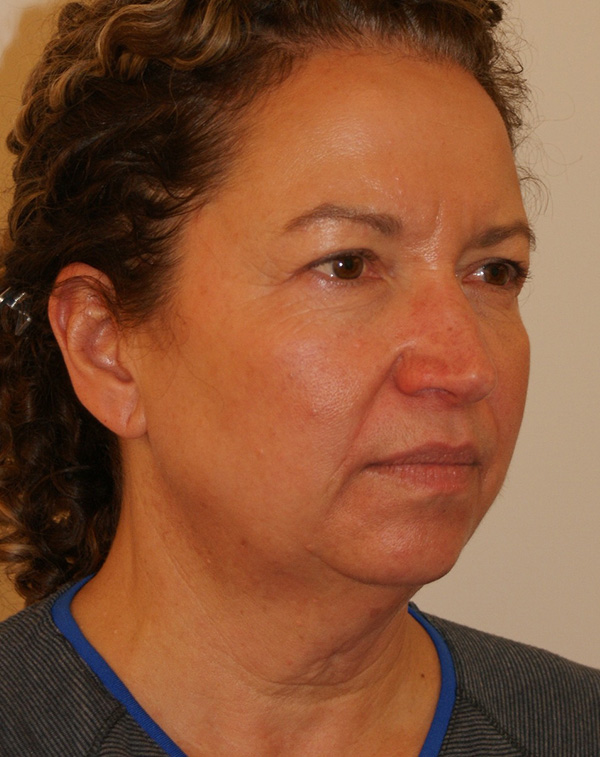 Photo of Patient 28 Before Face And Neck Lift Procedure