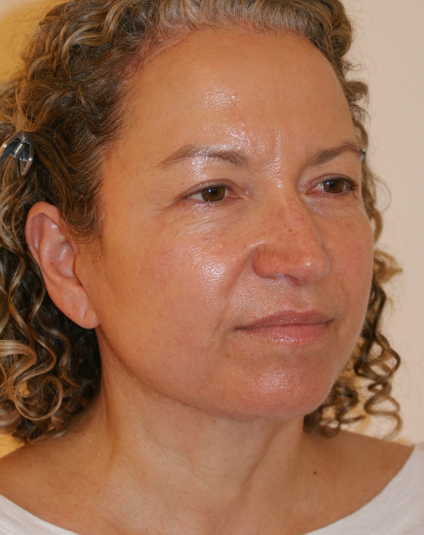 Photo of Patient 28 After Face And Neck Lift Procedure