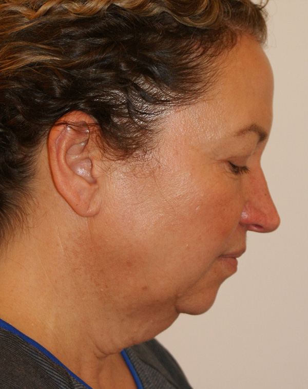 Photo of Patient 28 Before Face And Neck Lift Procedure
