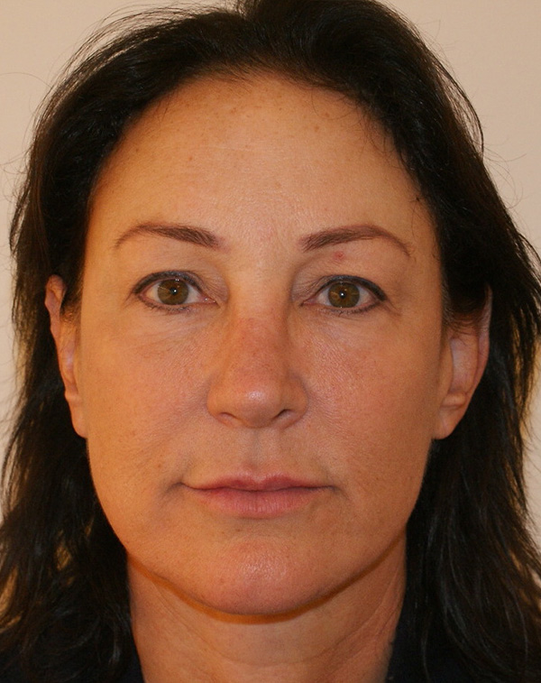 Face And Neck Lift Gallery Patient 29