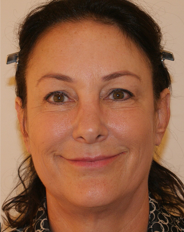 Photo of Patient 29 Before Face And Neck Lift Procedure