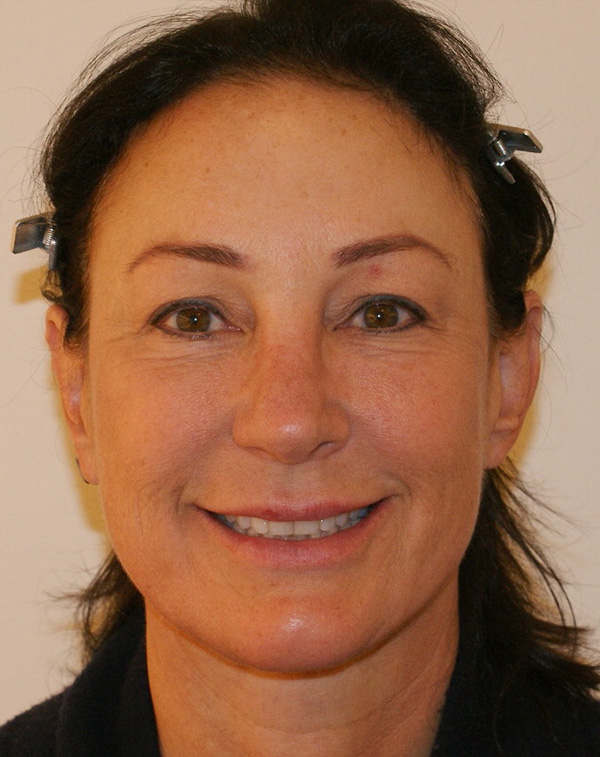 Photo of Patient 29 After Face And Neck Lift Procedure