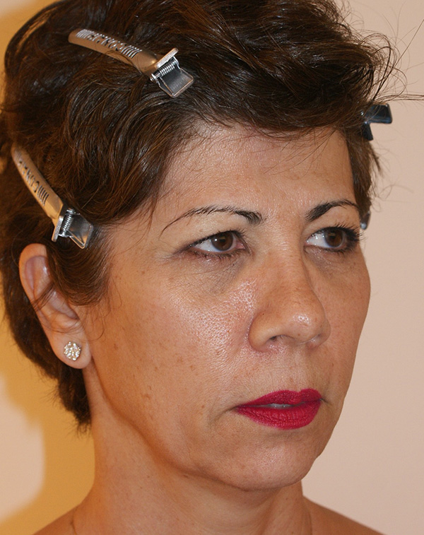 Photo of Patient 30 Before Face And Neck Lift Procedure