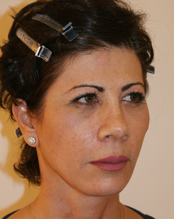 Photo of Patient 30 After Face And Neck Lift Procedure