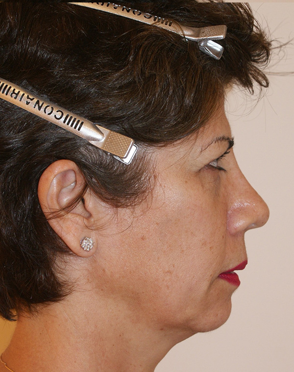 Photo of Patient 30 Before Face And Neck Lift Procedure