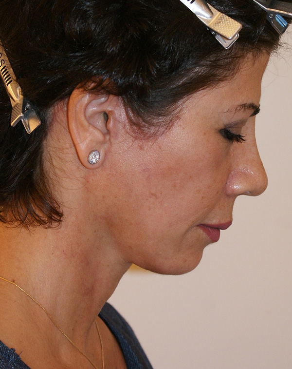 Photo of Patient 30 After Face And Neck Lift Procedure