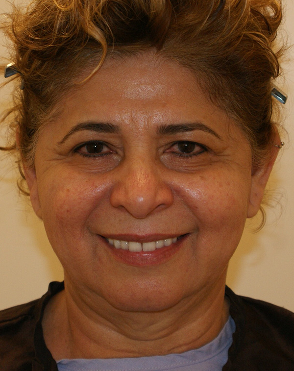 Photo of Patient 31 Before Face And Neck Lift Procedure