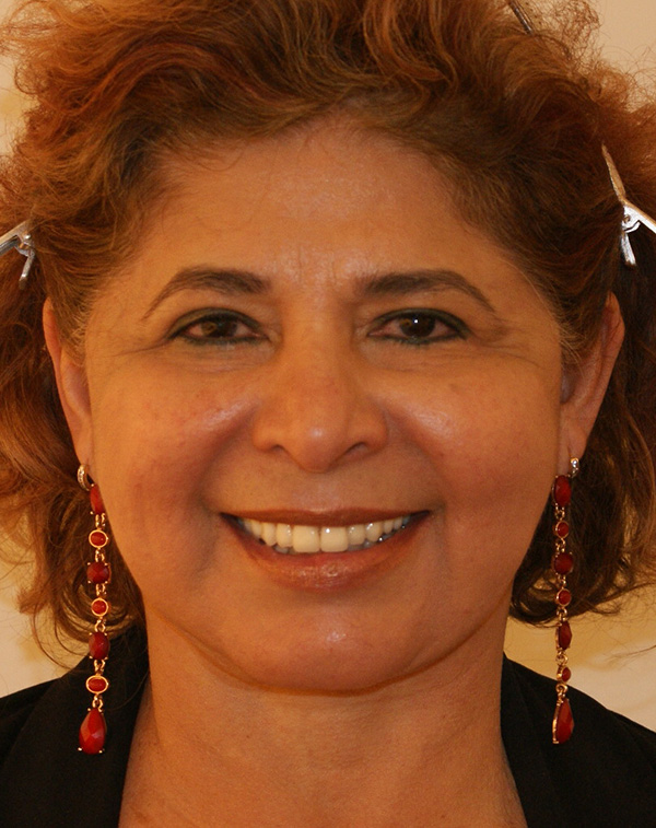 Photo of Patient 31 After Face And Neck Lift Procedure