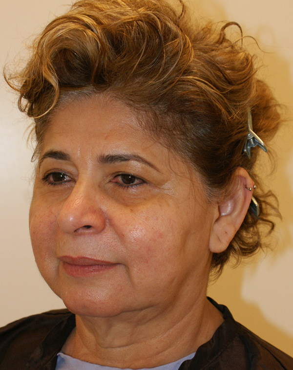 Photo of Patient 31 Before Face And Neck Lift Procedure