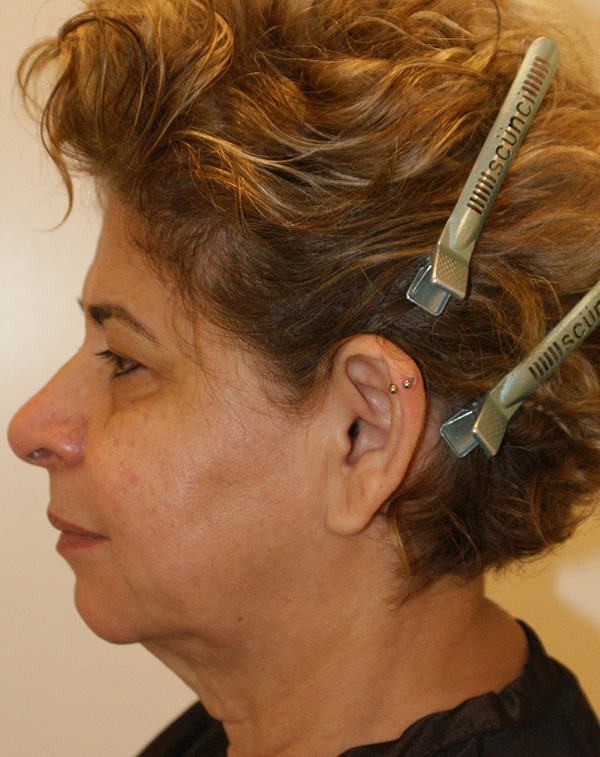 Photo of Patient 31 Before Face And Neck Lift Procedure