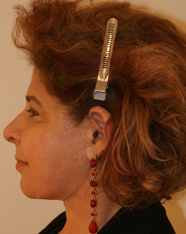 Photo of Patient 31 After Face And Neck Lift Procedure