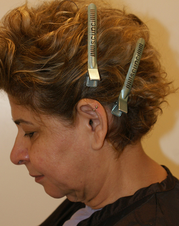 Photo of Patient 31 Before Face And Neck Lift Procedure