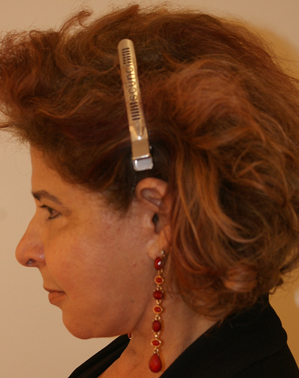 Photo of Patient 31 After Face And Neck Lift Procedure