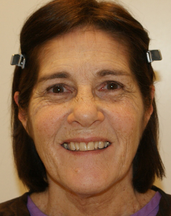 Photo of Patient 32 Before Face And Neck Lift Procedure