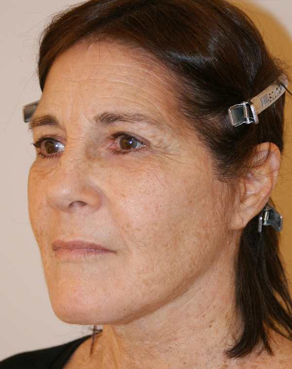 Photo of Patient 32 After Face And Neck Lift Procedure