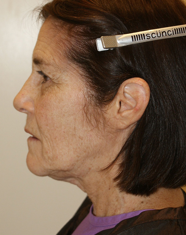 Photo of Patient 32 Before Face And Neck Lift Procedure