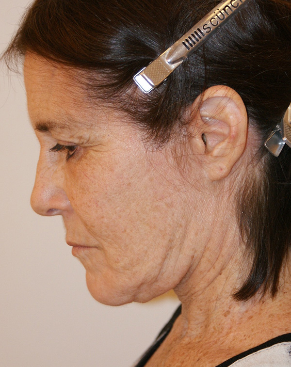 Photo of Patient 32 After Face And Neck Lift Procedure