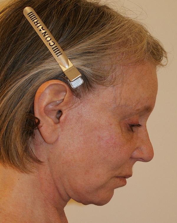 Photo of Patient 33 After Face And Neck Lift Procedure