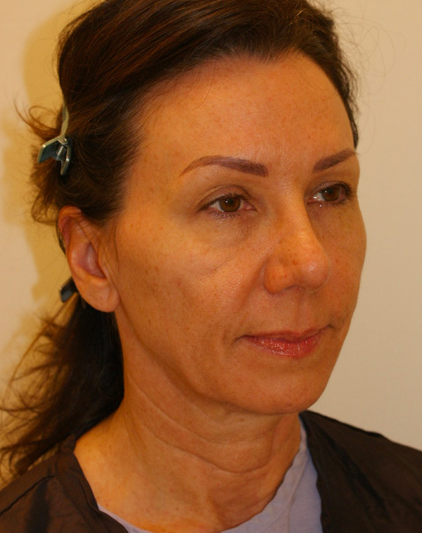 Photo of Patient 34 Before Face And Neck Lift Procedure