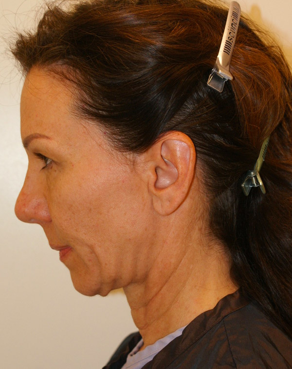 Photo of Patient 34 Before Face And Neck Lift Procedure