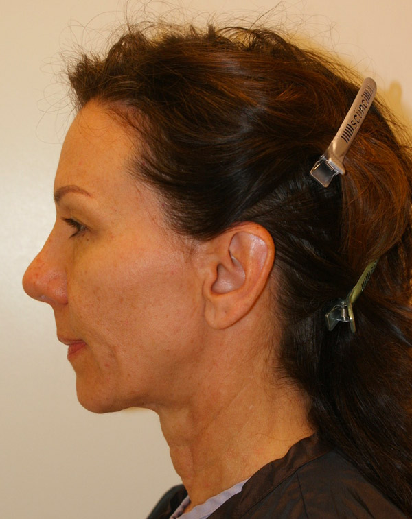 Photo of Patient 34 Before Face And Neck Lift Procedure