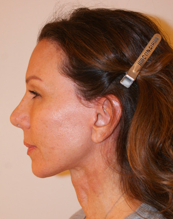 Photo of Patient 34 After Face And Neck Lift Procedure