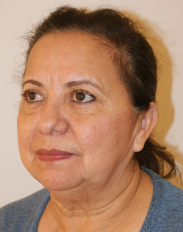 Photo of Patient 35 Before Face And Neck Lift Procedure