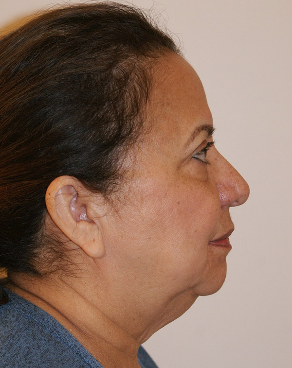 Photo of Patient 35 Before Face And Neck Lift Procedure
