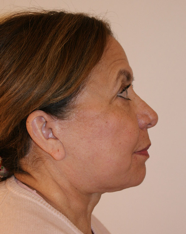 Photo of Patient 35 After Face And Neck Lift Procedure