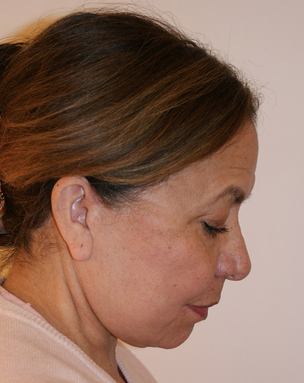 Photo of Patient 35 After Face And Neck Lift Procedure