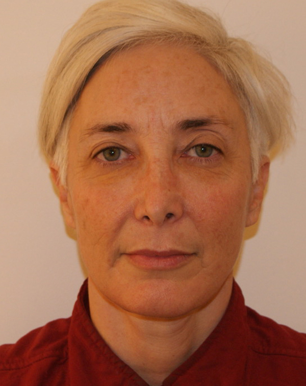 Face And Neck Lift Gallery Patient 36