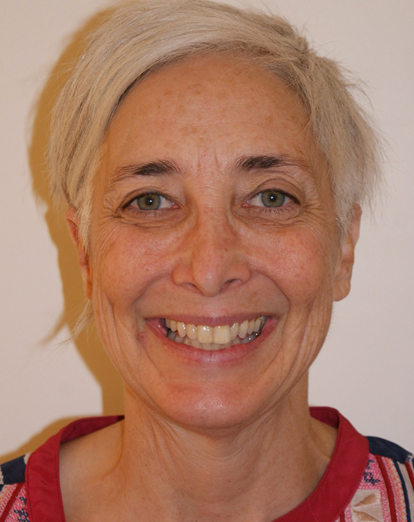 Photo of Patient 36 Before Face And Neck Lift Procedure