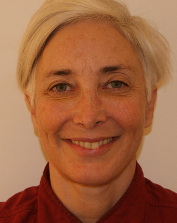 Photo of Patient 36 After Face And Neck Lift Procedure