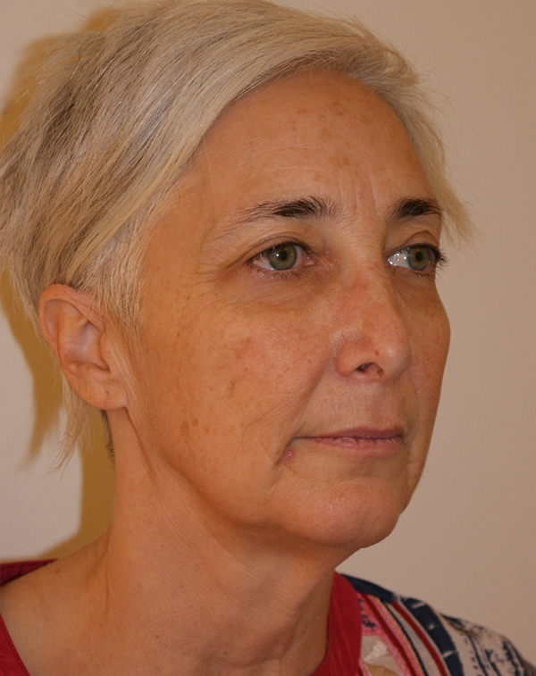 Photo of Patient 36 Before Face And Neck Lift Procedure