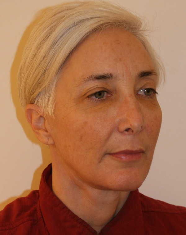 Photo of Patient 36 After Face And Neck Lift Procedure