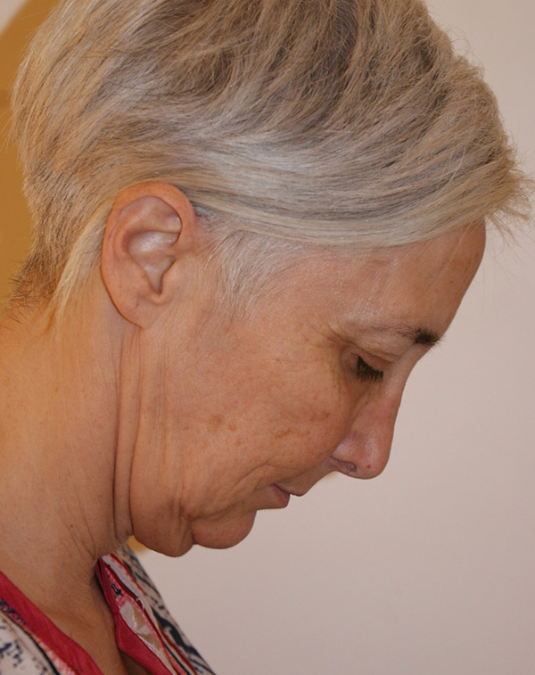 Photo of Patient 36 Before Face And Neck Lift Procedure
