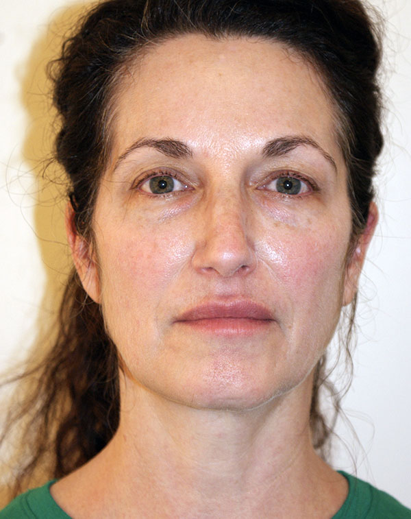 Photo of Patient 01 Before Facial Fat Transfer Procedure