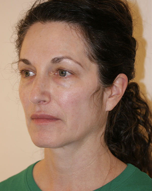 Photo of Patient 01 Before Facial Fat Transfer Procedure