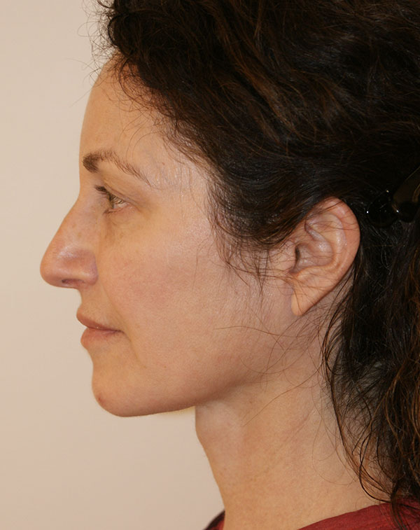 Photo of Patient 01 After Facial Fat Transfer Procedure