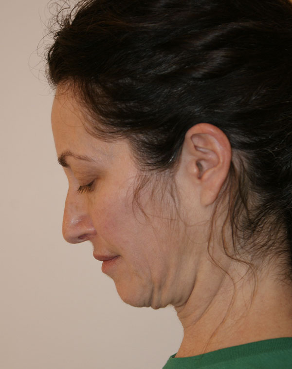 Photo of Patient 01 Before Facial Fat Transfer Procedure