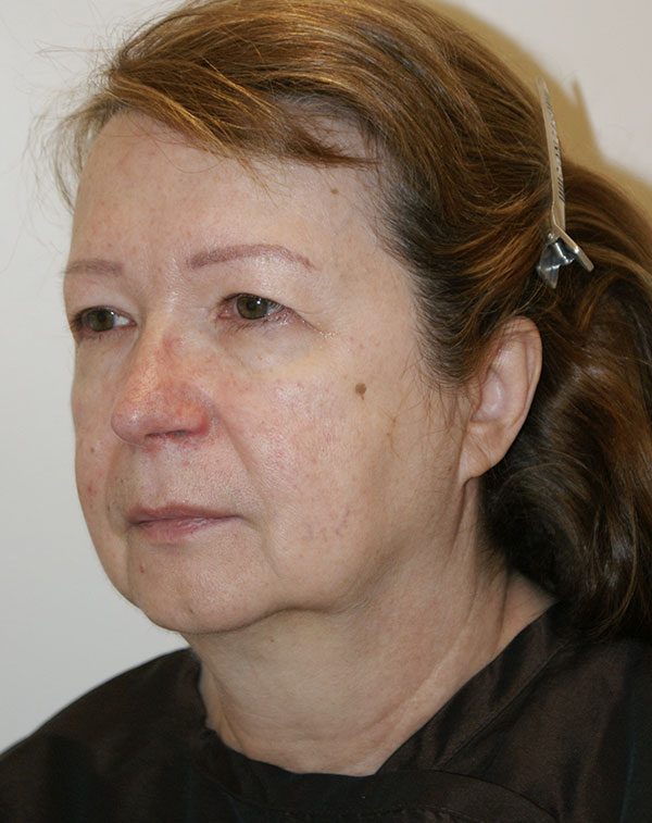 Photo of Patient 03 Before Facial Fat Transfer Procedure