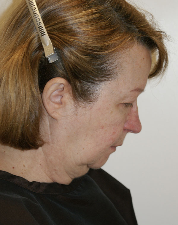 Photo of Patient 03 Before Facial Fat Transfer Procedure
