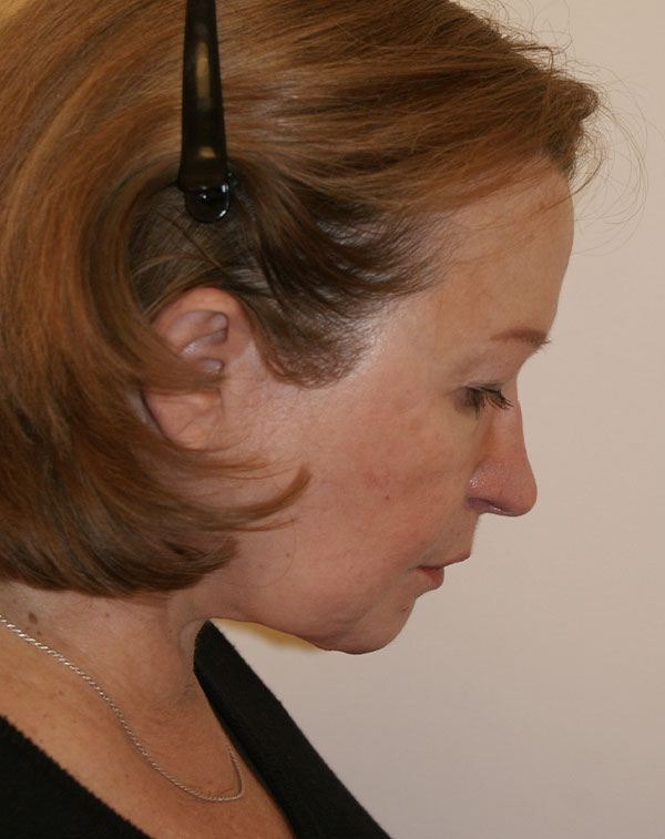Photo of Patient 03 After Facial Fat Transfer Procedure