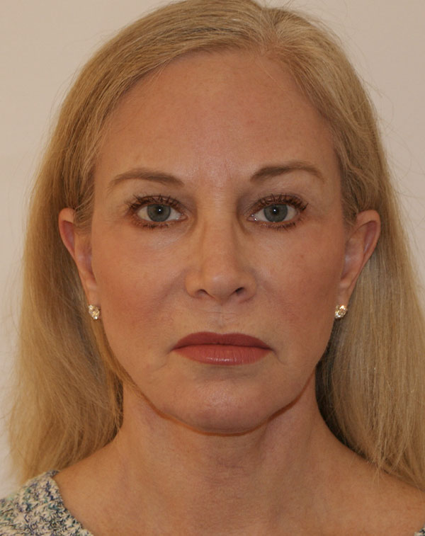 Photo of Patient 04 After Facial Fat Transfer Procedure
