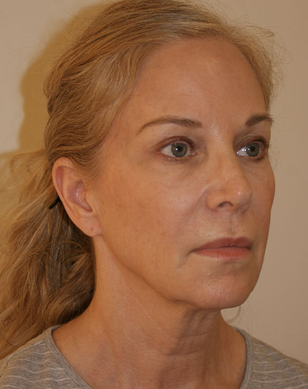 Photo of Patient 04 Before Facial Fat Transfer Procedure